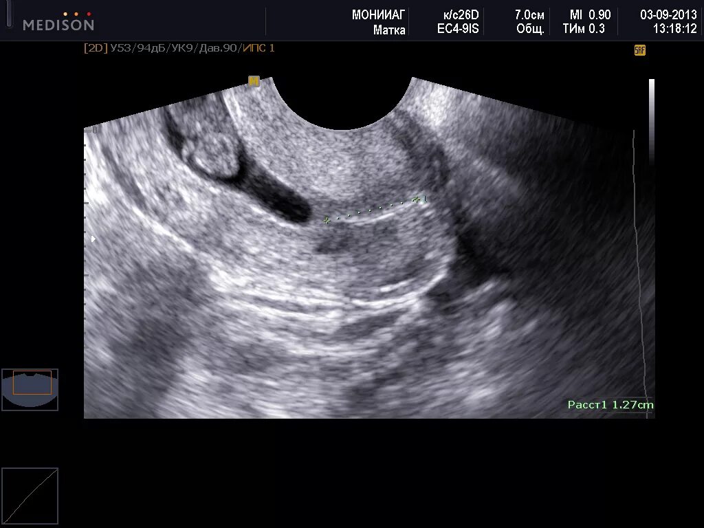 Размер полости матки. Ультразвуковое исследование шейки матки УЗИ-цервикометрия. Шейки матки цервикометрия 39мм. УЗИ шейки матки цервикометрия.