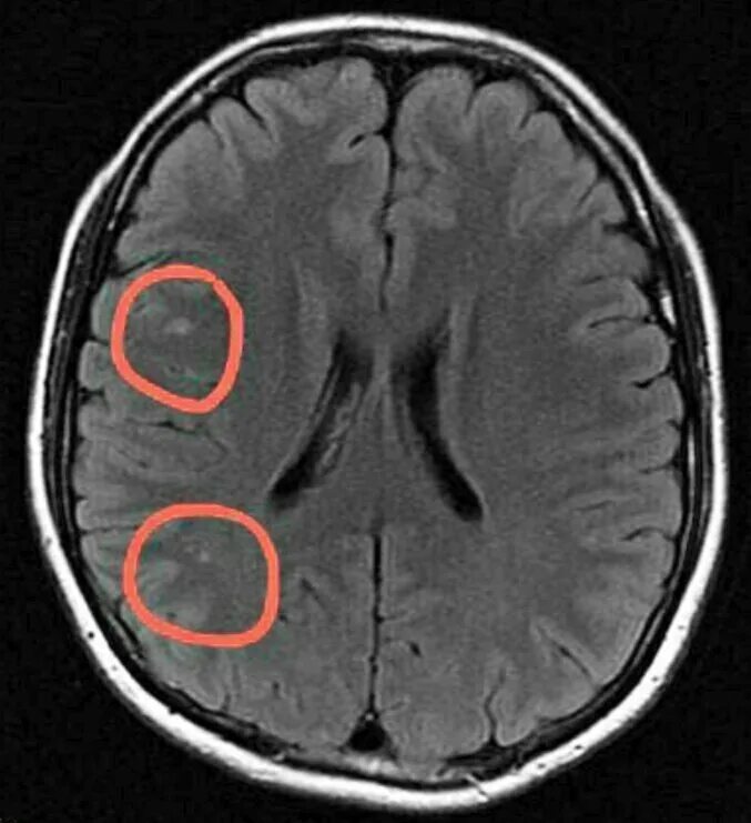 Множественный глиоз мозга. Кортикальный глиоз. Глиоз мозга на мрт. Лакунарный глиоз. Единичный очаг глиоза мрт.