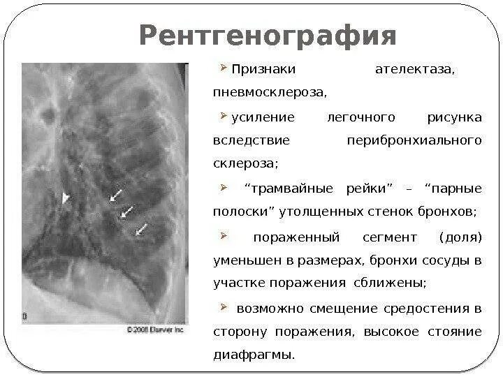 Умеренные фиброзные изменения