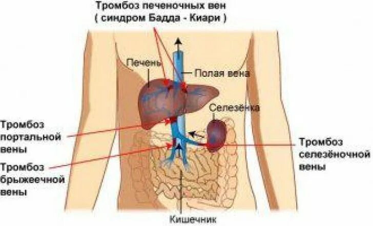 Портальная гипертензия тромбоз воротной вены. Тромбоз печеночных вен синдром Бадда-Киари. Клинические проявления болезни Бадда Киари. Цирроз печени при синдроме Бадда Киари. Тромбоз вены печени