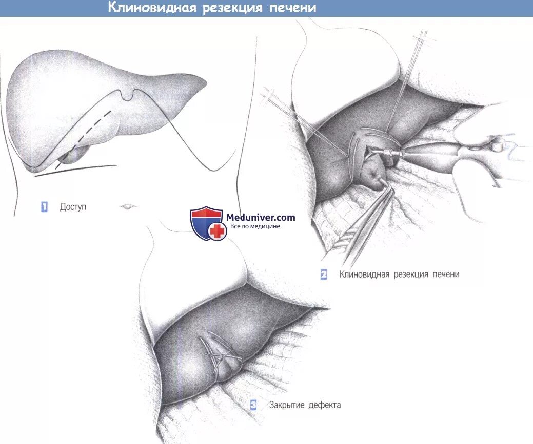 Операция резекция печени. Атипичная клиновидная резекции печени. Лобэктомия – резекция доли печени;. Атипичная резекция печени показания. Краевая и клиновидная резекция печени.