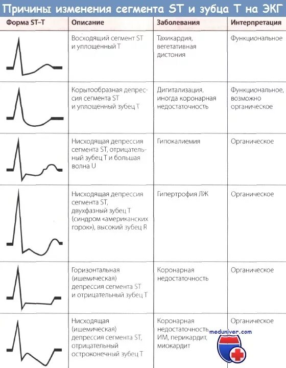 Критерии ишемии. Зубцы в сегменте St на ЭКГ. Депрессия St v4-v6 ЭКГ. Сегмент St на ЭКГ В норме. Сегмент St на ЭКГ В норме и патологии.