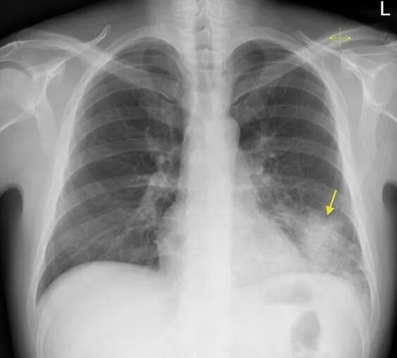 Муцинозная аденокарцинома легкого кт. Стекло в легких. Солитарные метастазы в легких. Матовое стекло пневмония рентген. Коронавирус пневмония рентген.