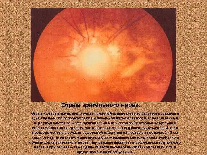 Аномалия развития зрительного нерва. Омертвление зрительного нерва. Разрыв зрительного нерва. Симптоматика разрыва зрительного нерва. Контузия зрительного нерва.