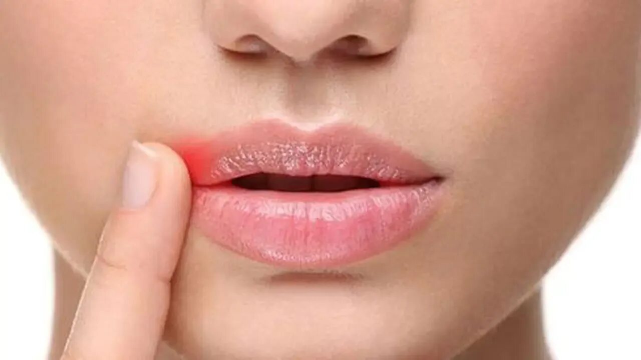 Красные губы как лечить. Красные губы как лечить