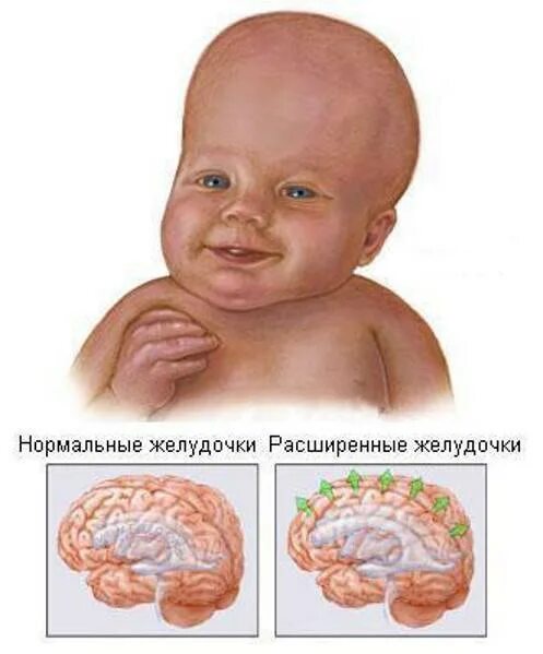 Расширение желудочков у новорожденного