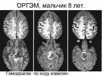 Демиелинизация головного