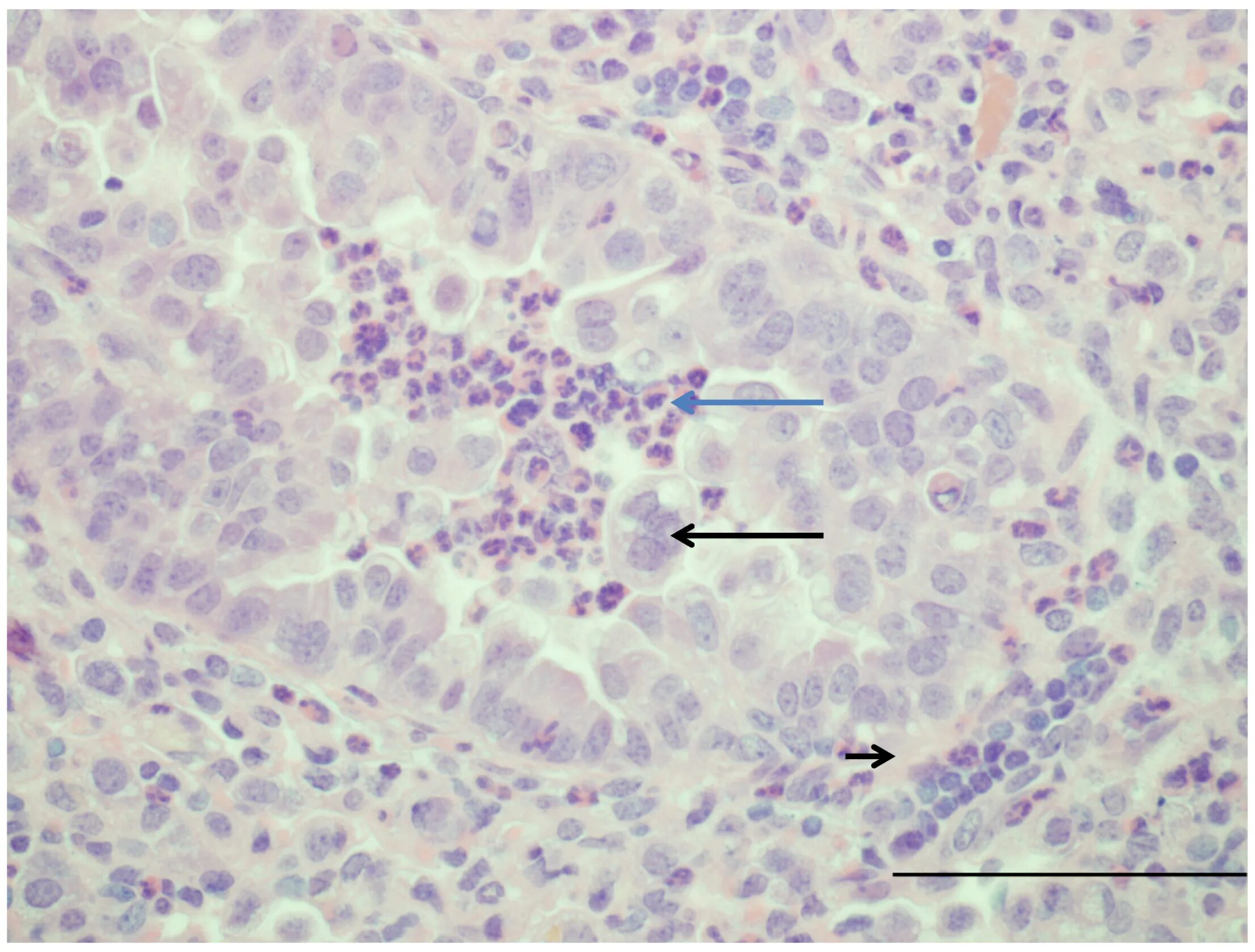 Syncytial virus. Респираторно синцитиальная инфекция патанатомия. Респираторно-синцитиальная инфекция патологическая анатомия. Респираторно синцитиальная инфекция пневмония. Респираторно-синцитиальная инфекция микропрепарат.