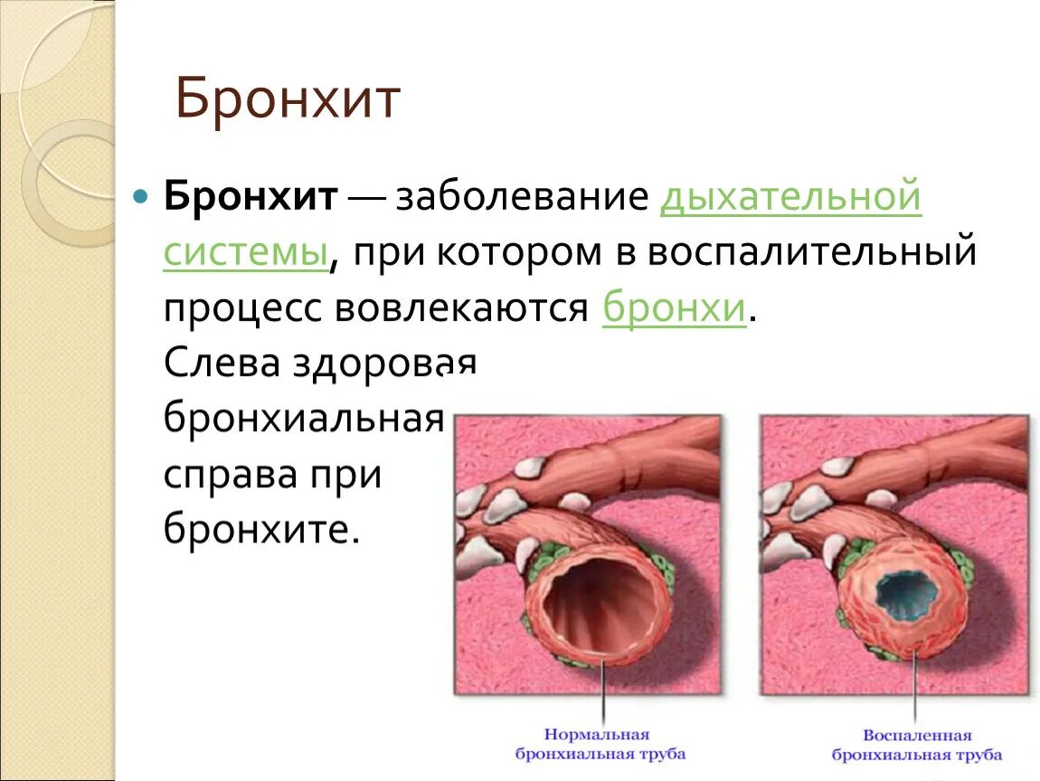 Острый респираторные заболевания - острый бронхит. Острый и хронический бронхит презентация. Заболевания органов дыхания бронхит.