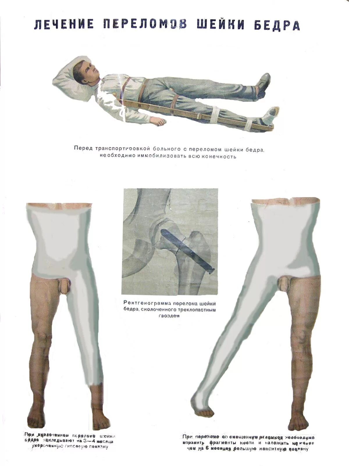 Шейка бедра в ноге. Перелом тазобедренного сустава иммобилизация. Перелом шейки бедра наложение гипса. Положение конечности при переломе шейки бедра. Перелом шейки бедра иммобилизация шиной.