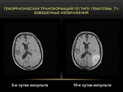 Геморрагическая трансформация ишемического инсульта