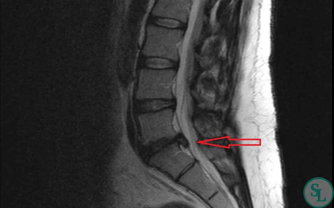 Позвоночник отделы l5 s1. Грыжа диска позвоночника l5 s1. Секвестрированная грыжа l5-s1. Секвестрированная грыжа мрт. Грыжа l5-s1.