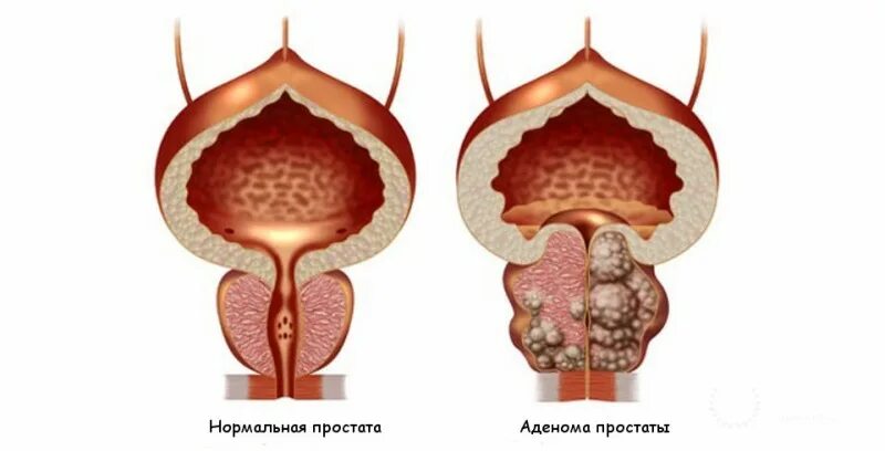 Гиперплазия простаты что это такое