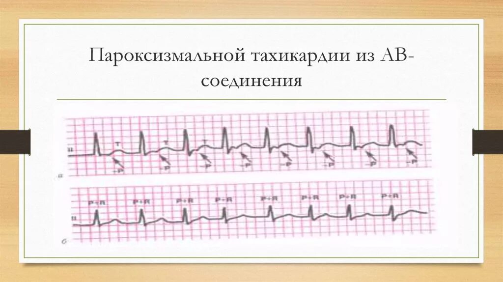Атриовентрикулярная тахикардия. Пароксизмальная тахикардия с узким комплексом qrs на экг. Пароксизмальной ав тахикардии. Av узловая тахикардия на экг. Предсердная и желудочковая пароксизмальная тахикардия.