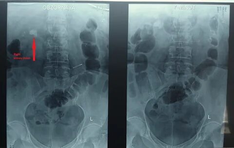 Дистанционная литотрипсия камней почек в Ташкенте. Дробление камней почек в Ташк