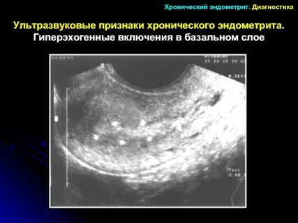 Воспаление эндометрии