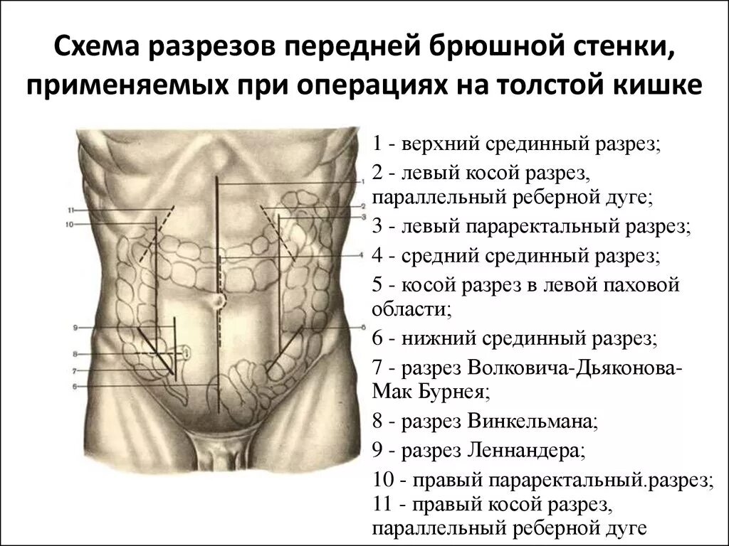 Живот стенки полости живота. Параректальный разрез передней брюшной стенки. Брюшная стенка топографическая анатомия. Срединная поперечная лапаротомия. Доступы через переднюю брюшную стенку.