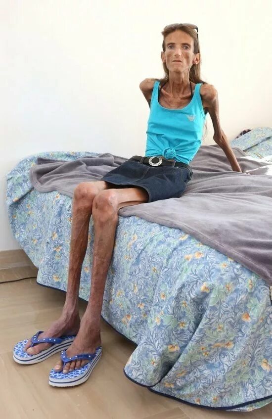 Покажите самых худых. Покажите самых худых. Джоди кидд анорексия. Самый худой человек в мире лючия сарате. Покажите самых худых.