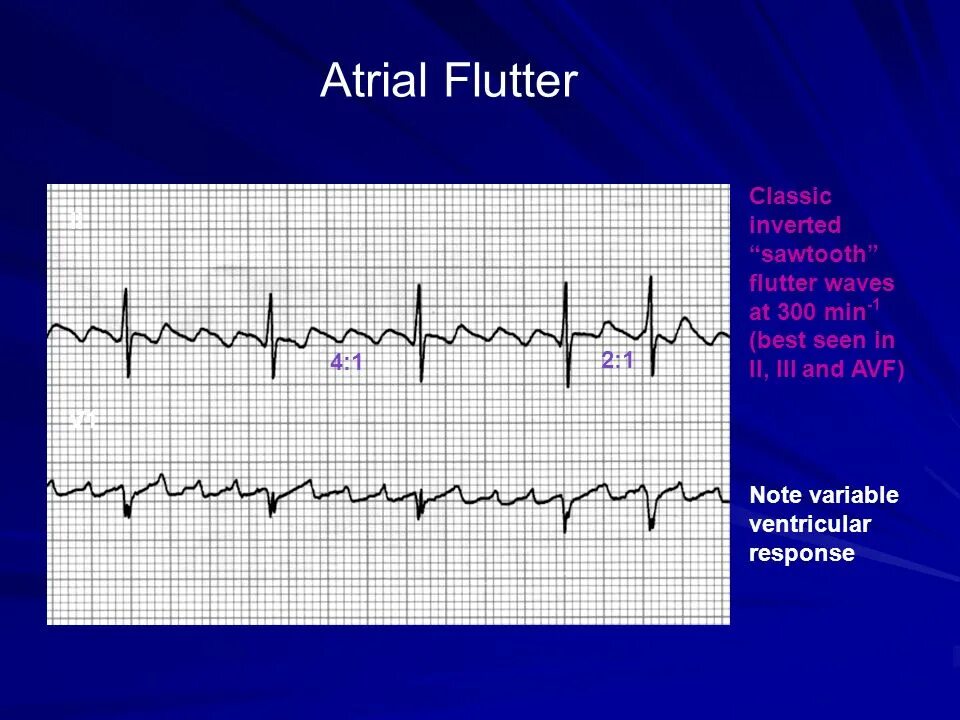 Atrial Flutter. Atrial Flutter ECG. Atrial Flutter 1.1. Atrial Fibrillation Atrial Flutter. Flutter перевод