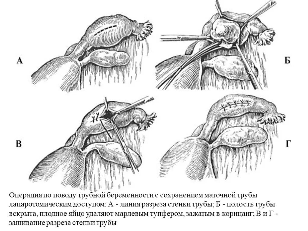 Операции матки и трубы. Внематочная Трубная беременность. Операция. Операции при трубной беременности. Этапы операции при внематочной беременности. Операции при внематочной (трубной) беременности.