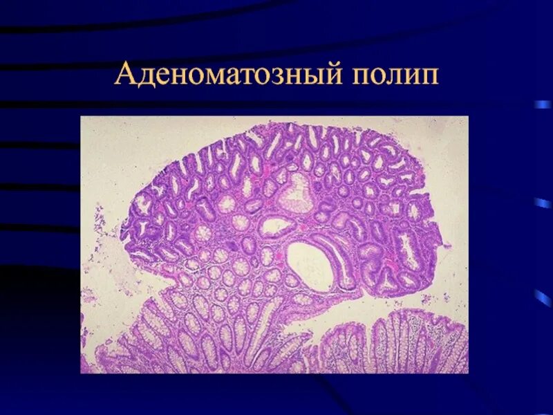 Микровезикулярный полип толстой кишки. Аденоматозный полип желудка гистология. Полип толстой кишки микропрепарат. Полип толстой кишки макропрепарат. Полип кишки гистология.