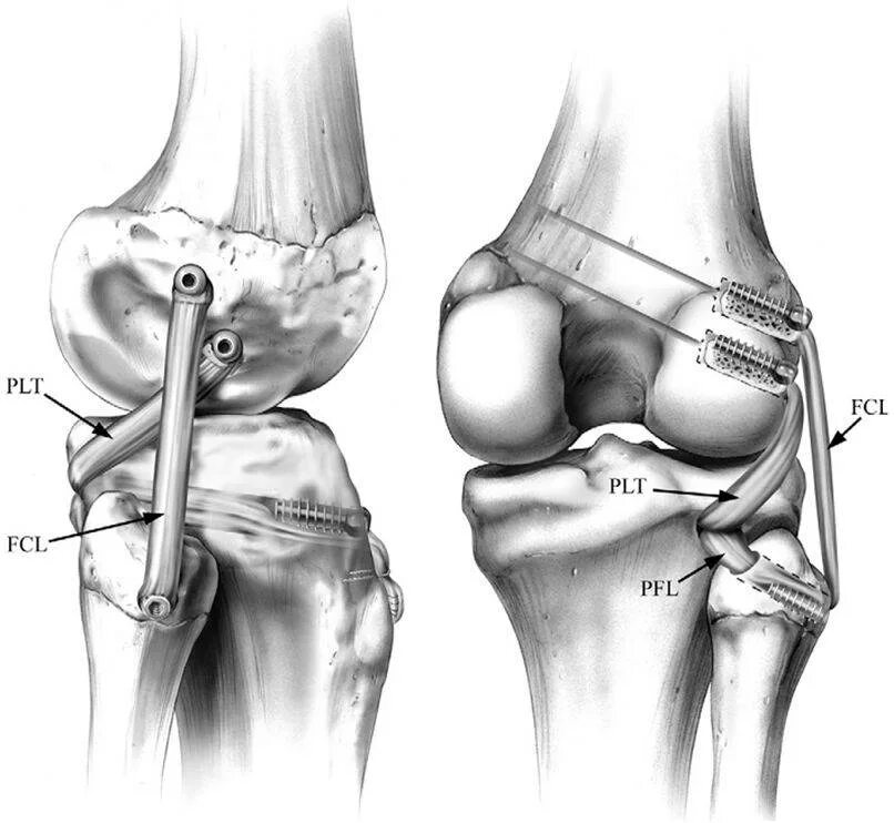 Повреждение медиального мыщелка. Медиальная связка коленного сустава. Наружная коллатеральная связка коленного сустава. Медиальная боковая связка коленного сустава. Крестообразные связки коленного сустава анатомия.