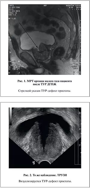 Реабилитация после тур аденомы простаты. УЗИ предстательной железы Изранов. Анатомия предстательной железы Изранов. УЗИ после тур предстательной железы. Состояние после тур предстательной железы.