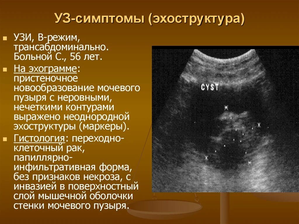 Мочевой пузырь после удаления матки