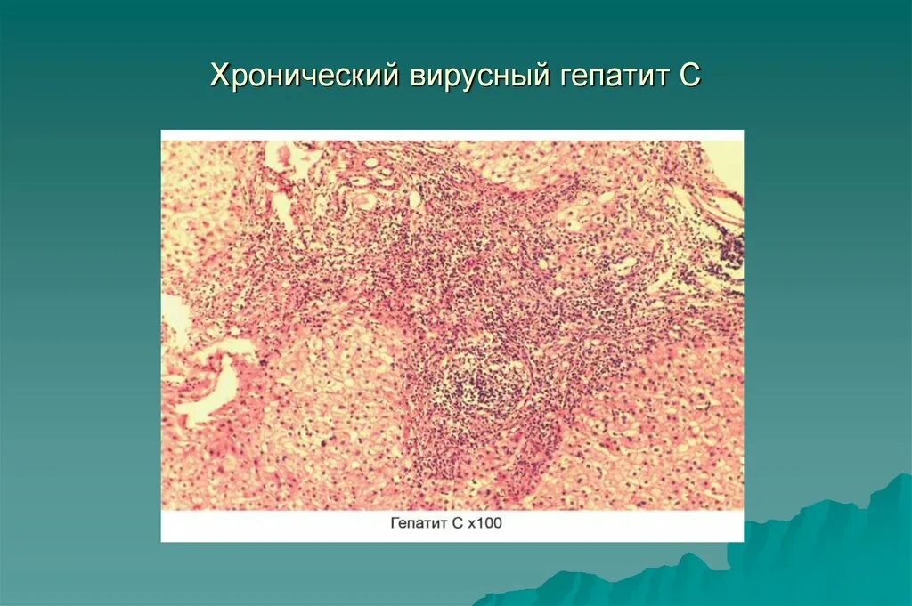 Вирусный гепатит печени. Хронический инфекционный гепатит. Печень при хроническом гепатите. Хронический вирусный гепатит c.