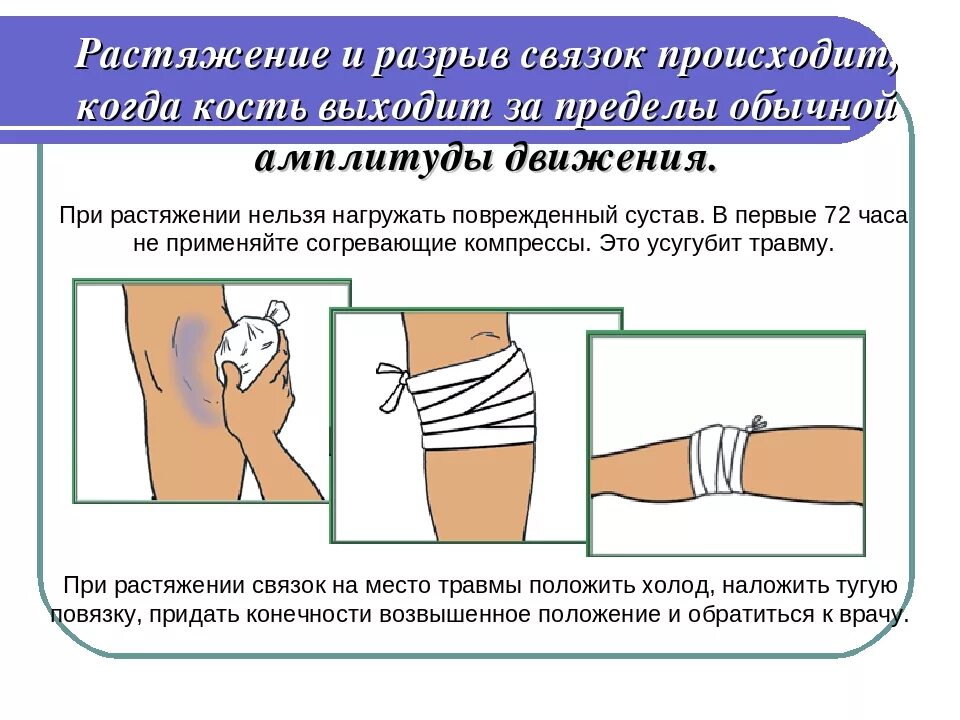 Растяжение это. Пмп при растяжении связок. пмп при растяжении и разрыве связок. растяжение первая медицинская помощь.