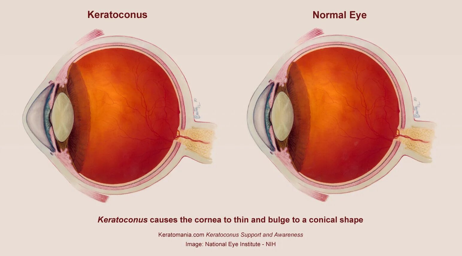 Когда восстанавливается зрение после замены хрусталика. Кератоконус роговицы глаз. Заболевание глаз кератоконус. Болезнь роговицы кератоконус. Коническая роговица (кератоконус).