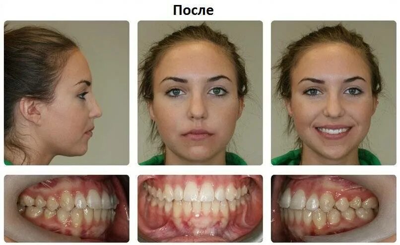 Мезиальный, глубокий, дистальный прикус. Мезиальный перекрестный прикус. Ортодонт мезиальный прикус. Неправильный прикус мезиальный. Изменения после брекетов