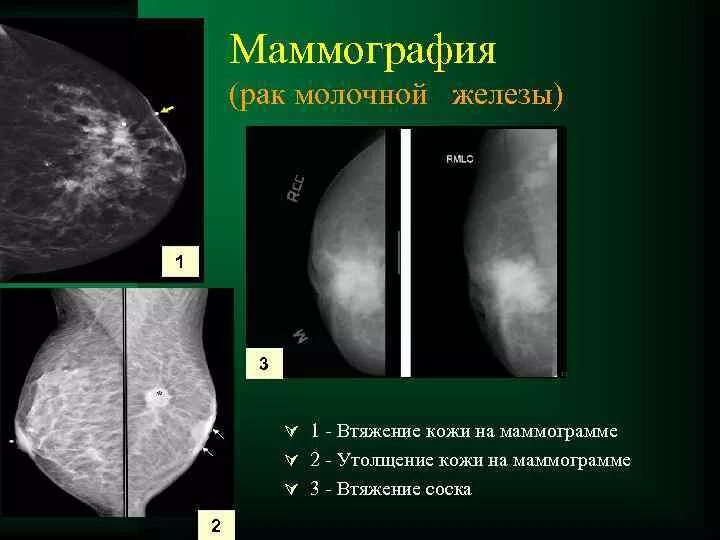 Классификация молочной железы. Пневмокистография молочной железы. Стадии рмж классификация. С 50. С 50.