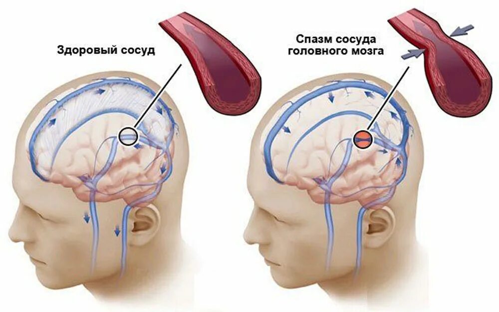 Спазм сосудов головного мозга. Сосудистый спазм головного мозга. Патология сосудов головного мозга. Холод внутри головы