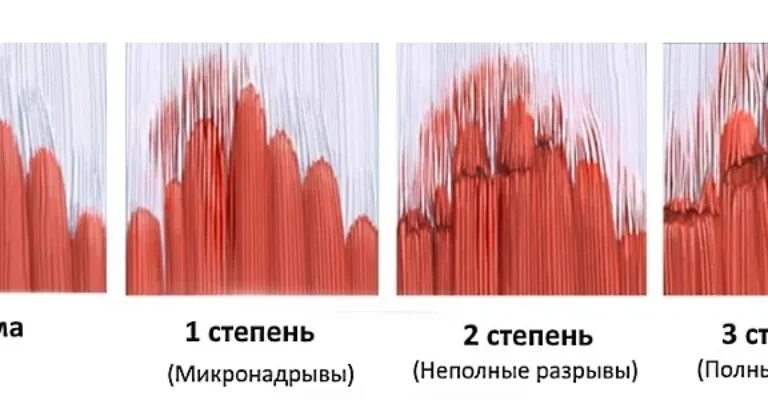 Микро разрыв мышечных волокон. Степени растяжения мышц. Микро разрыв мышечных волокон при тренировках. Степени повреждения мышц.