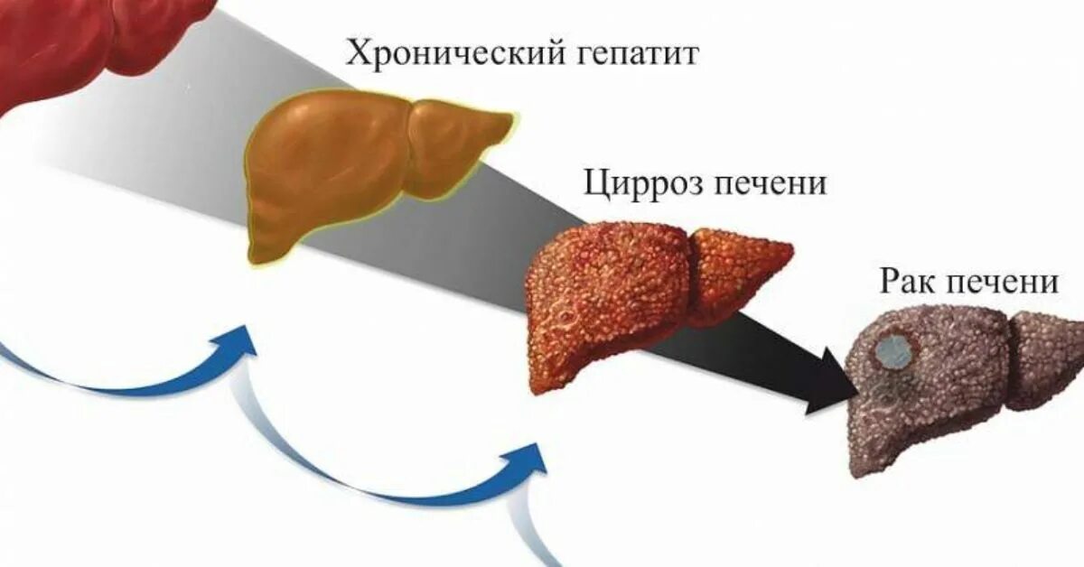 Как отличить печень. Цирроз печени гепатит b. Хронический гепатит и цирроз печени. Цирроз после вирусного гепатита.