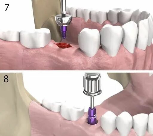 Имплант зуба формирователь. Формирователь десны на имплант что такое. Формирователь десневой манжетки. Формирователь десны и абатмент. Зубы импланты поэтапно