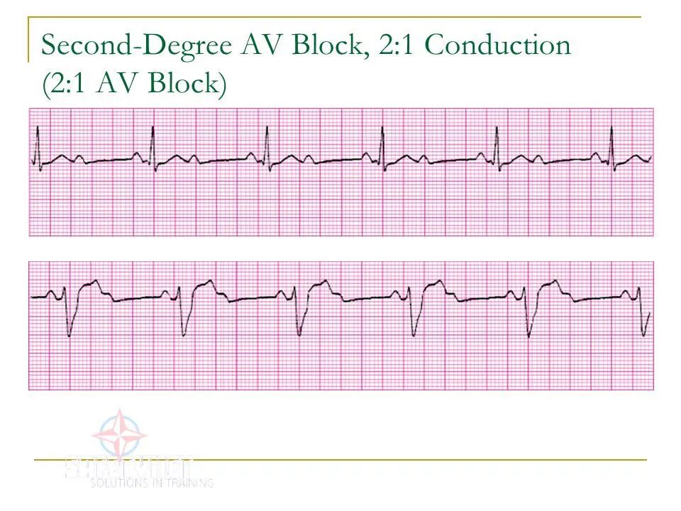 Av Blocks 3 degree ECG. Av Block 2. Second degree av Block Type 2. Second-degree av Block. Av блок