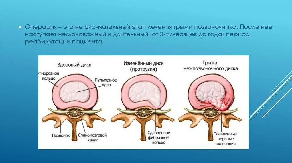 Грыжа позвоночника. Операция по удалению межпозвоночной грыжи. Грыжа диска позвоночника операция. Операция на межпозвоночную грыжу поясничного отдела. После операция грыжа диска