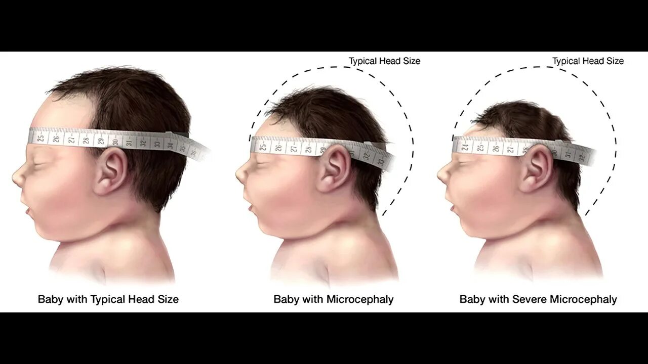 Внутриутробное недоразвитие головного мозга. Микроцефалия головного мозга. Микроцефалия форма черепа. Микроцефалия голова ребенка. Микроцефалия размер головы.