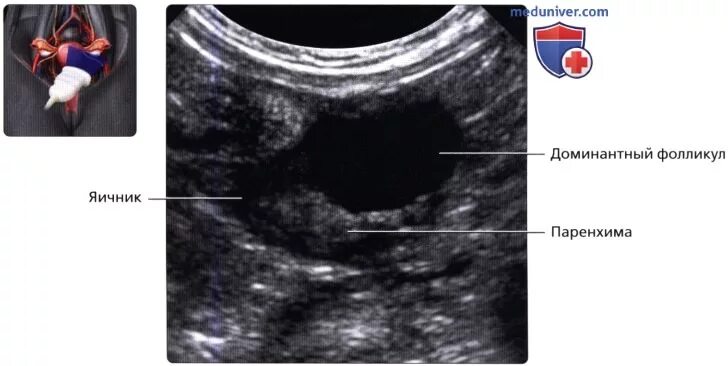 Яичники на УЗИ норма. Норма правого яичника