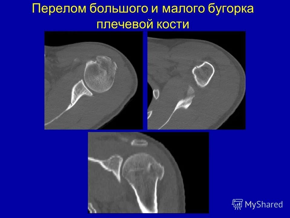 Гребень малого бугорка плечевой кости. Малый бугорок плечевой кости перелом. Малый бугорок плечевой кости перелом. Перелом головки плечевой кости рентген. Перелом большого бугорка плечевой кости без смещения рентген.
