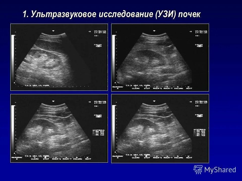 Узи брюшной полости полный мочевой пузырь. Ультразвуковое исследование почек и надпочечников. УЗИ почек и надпочечников норма. Ультразвуковое исследование почек (УЗИ).