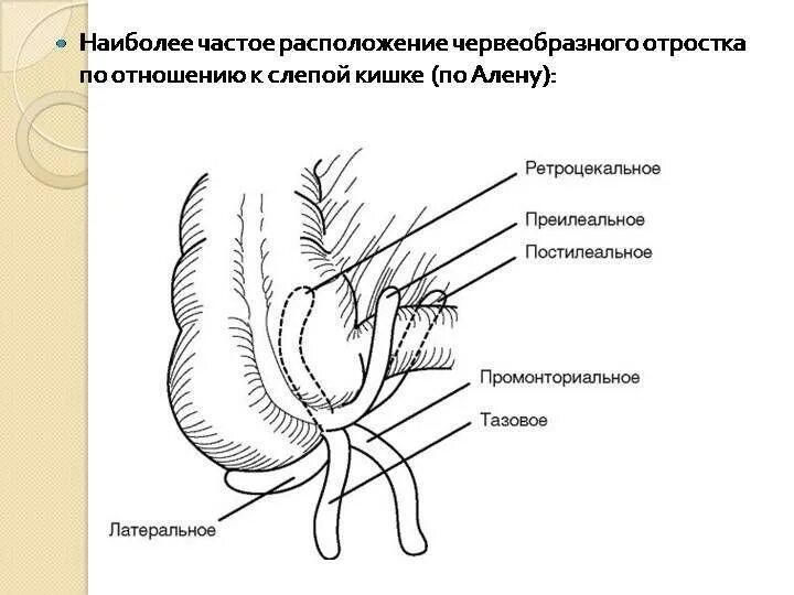 Червеобразный отросток анатомия расположение. Варианты положения червеобразного отростка. Атипичные положения червеобразного отростка. Атипичное положение червеобразного отростка. Локализация острого аппендицита