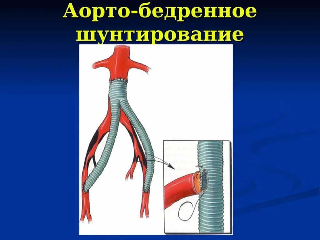 Шунт сосудов. Аорта коронарное шунтирование. Аорто коронарное бедренное шунтирование. Синдром Лериша аорто бедренное шунтирование. Бифуркационный аорто бедренный шунт.