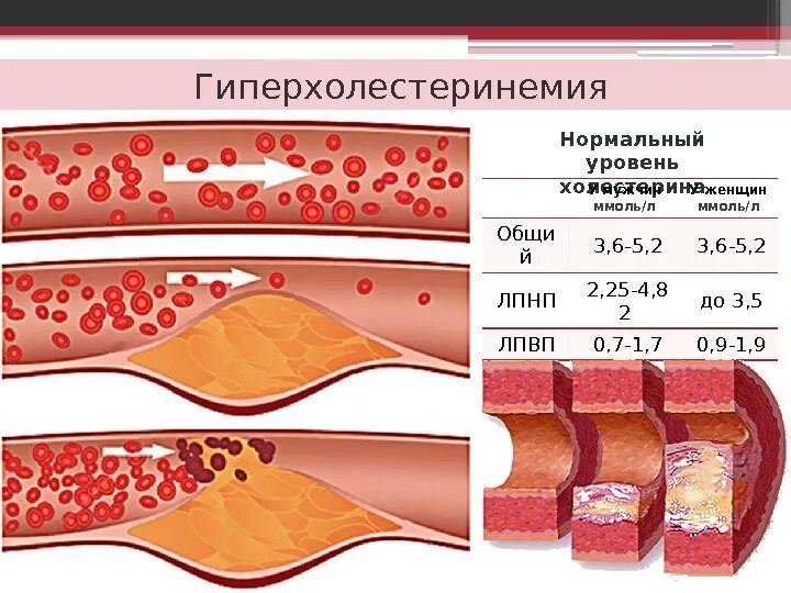 Гиперхолестеринемия. Гиперхолестеринемия холестерин. Гиперхолестеринемия это атеросклероз. Гиперхолестеринемия стадии. Наследственная гиперхолестеринемия