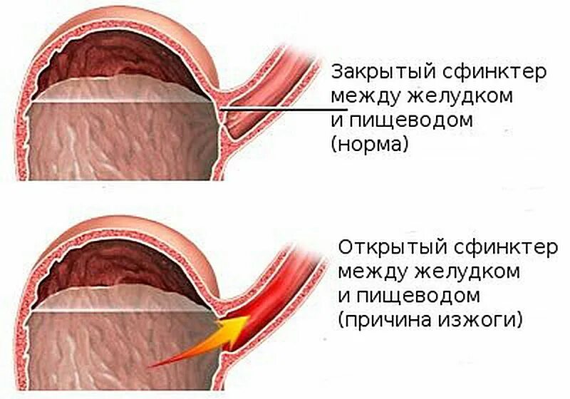 Почему изжога что делать. Сфинктер между желудком и пищеводом. Изжога причины. Причины появления изжоги.