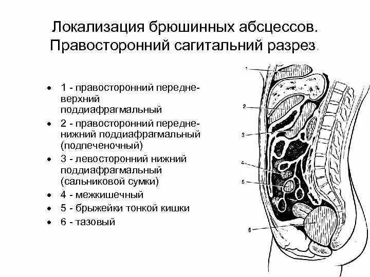 При передневерхней локализации абсцесс формируется. Правосторонний поддиафрагмальный абсцесс. перитонит сальниковой сумки. поддиафрагмальные абсцессы локализация.