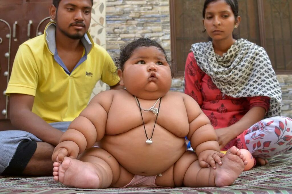 An 8-Month-Old Thick-Skinned Baby From Punjab Weighing 17 Kg Has Left The Doctor
