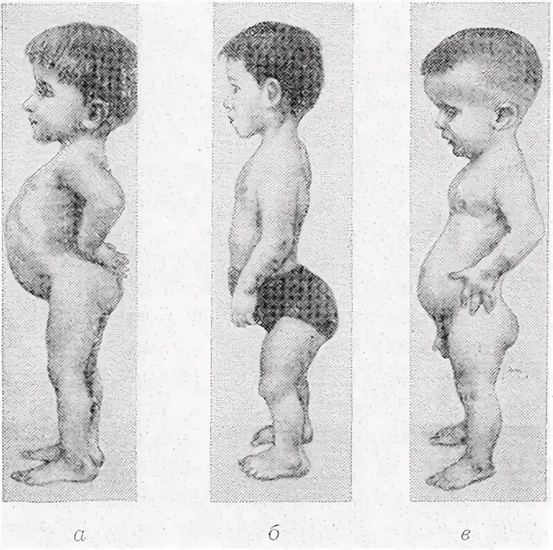 Спондилоэпифизарная дисплазия, оманский тип. Врожденной спондилоэпифизарной дисплазией. Спондилоэпифизарную дисплазию. Эпифизарная дисплазия бедренной кости. Спондилоэпифизарная дисплазия.